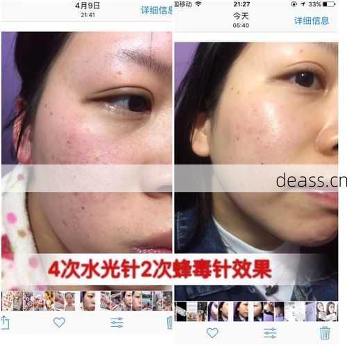 沈阳维修水光枪电话号哪里查?维修专家联系必备信息
